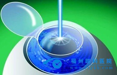 准分子激光近视手术可以用医保报销吗?