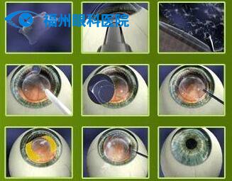 icl晶体植入术矫正近视的优势在哪里?_福州眼科医院
