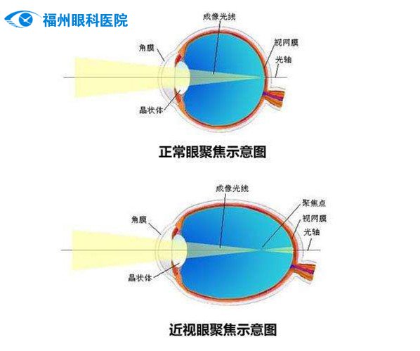 近视原因